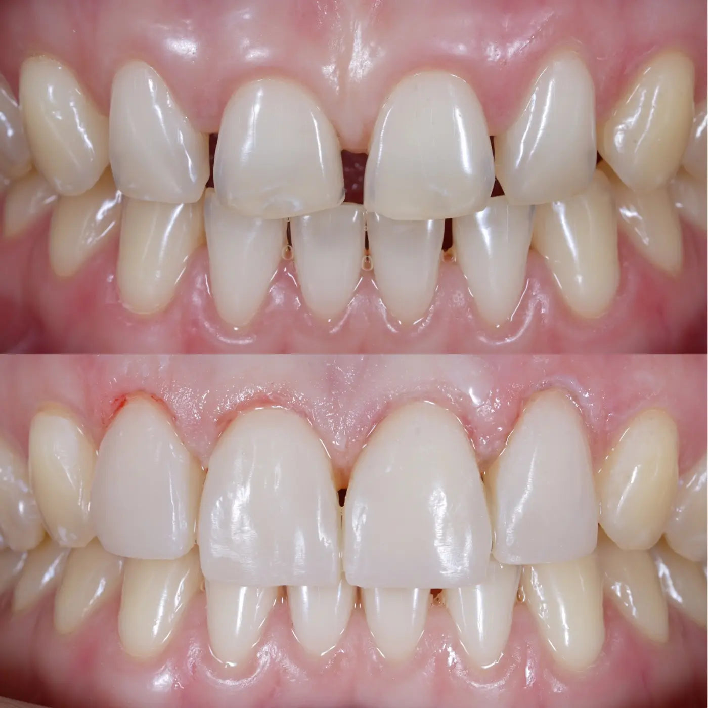 before after aesthetic composite to close gap between front teeth