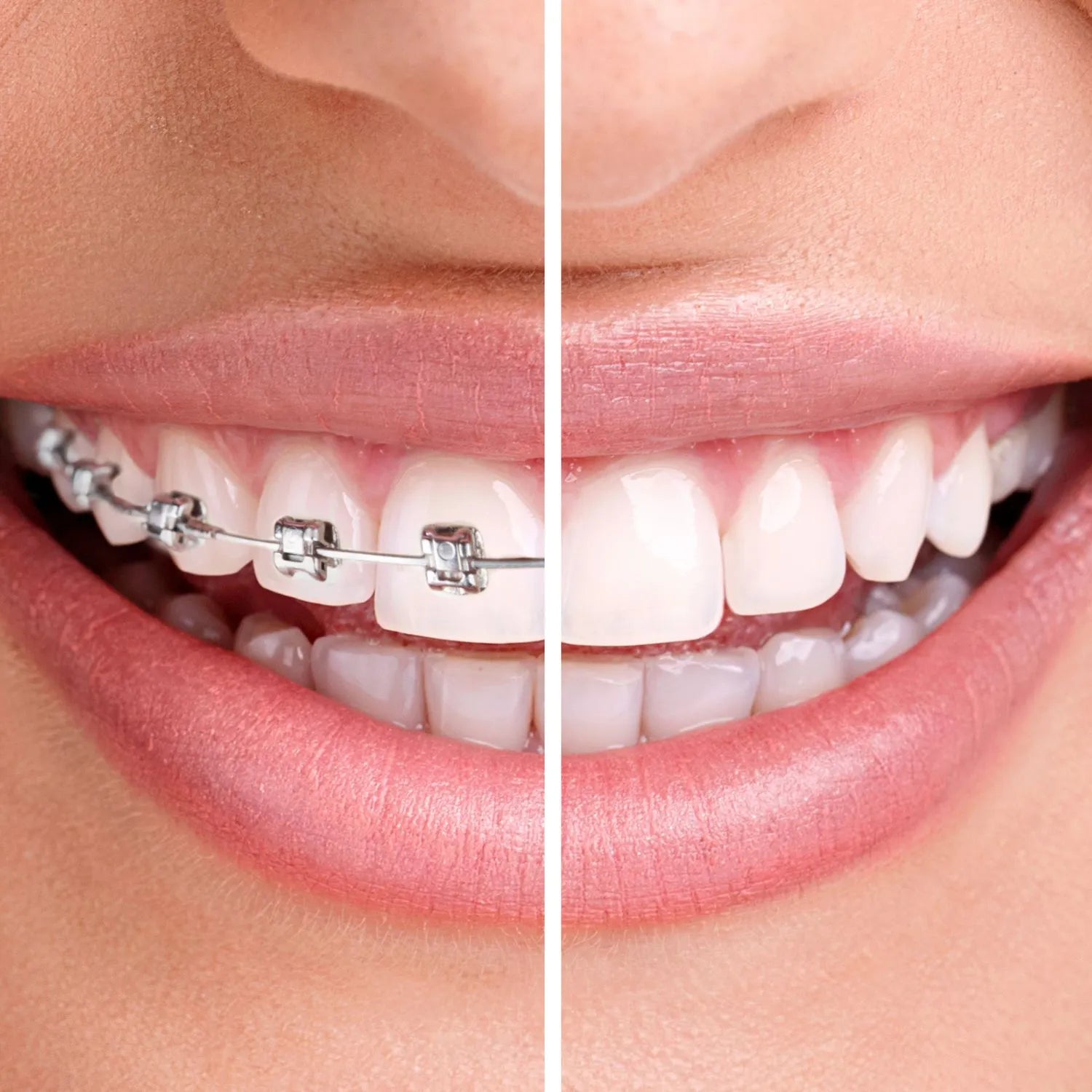 close up teeth one side with metal braces and other side without braces