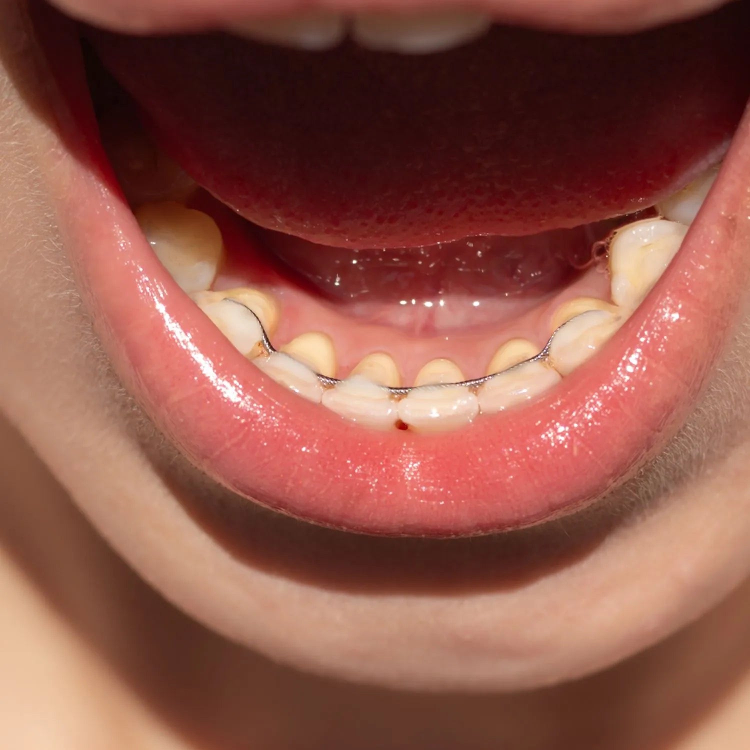 Mouth open showing a bonded retainer behind lower incisors and cuspids