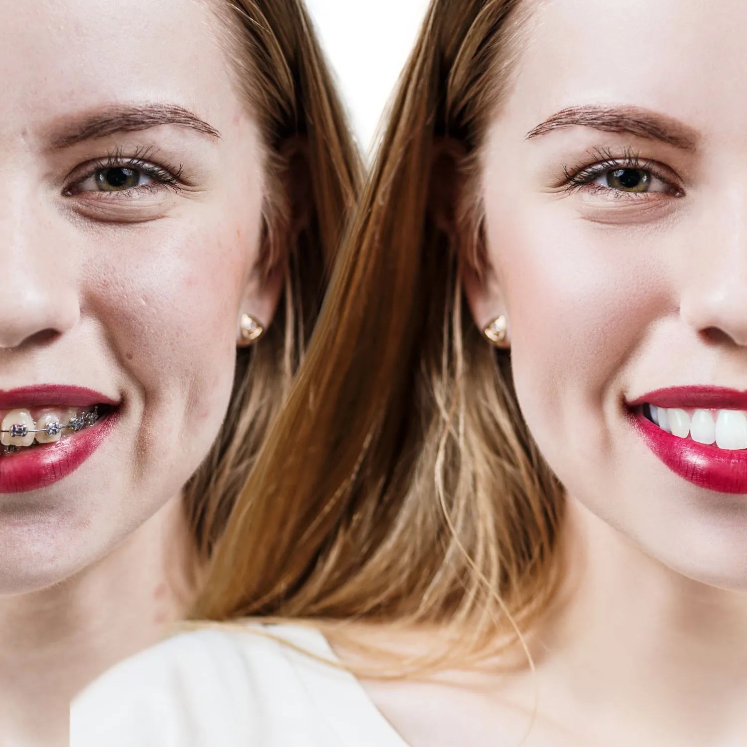 teeth before and after orthodontic treatment with fixed braces