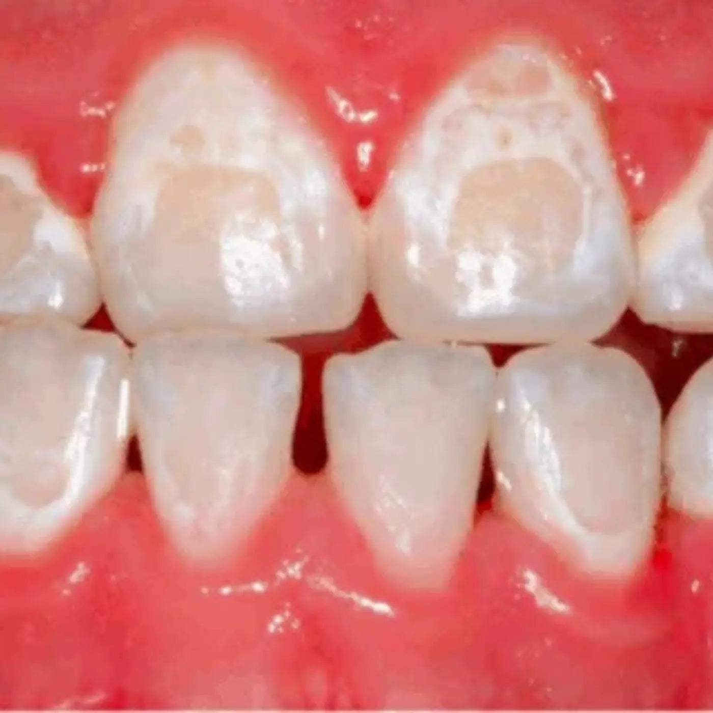 White Spots Around Braces? Here’s What You Need to Know
