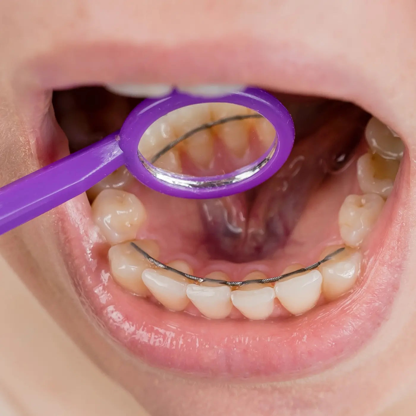 mirror in a mouth to show a bonded retainer 