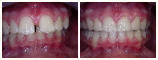 before after orthodontic treatment to solve protruding teeth