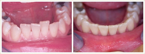 before after alignment lower teeth with orthodontic treatment