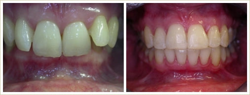 before after orthodontic treatment to solve severe deep bite
