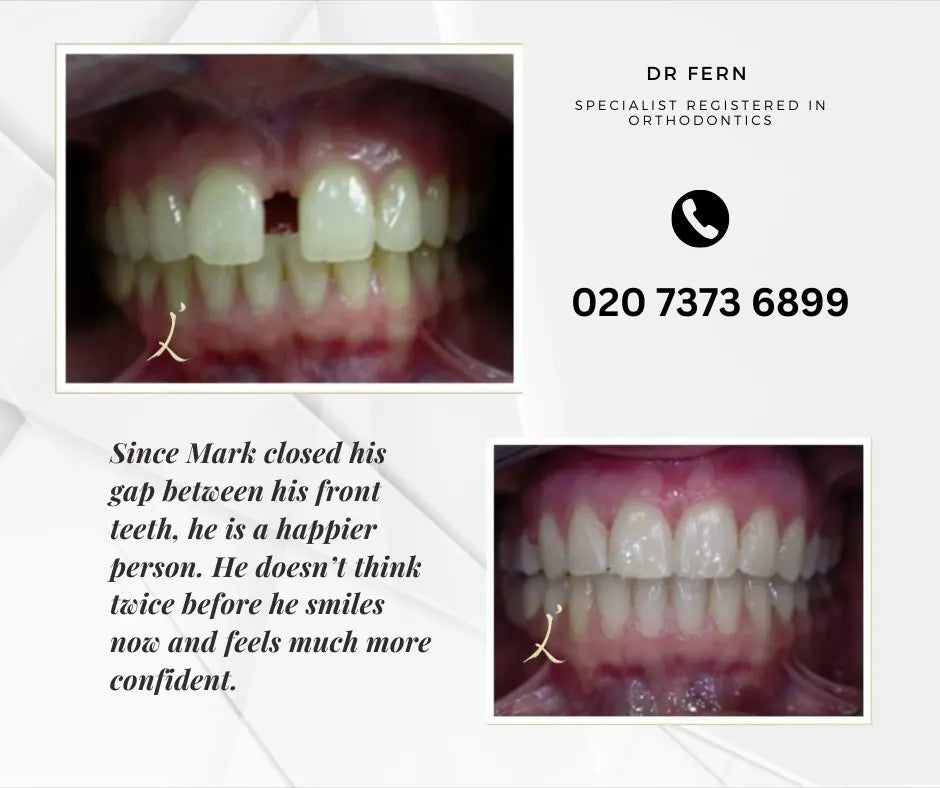 before and after orthodontic treatment closing gap between teeth