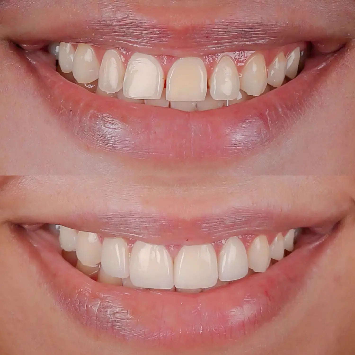 composite to close gaps between upper front teeth