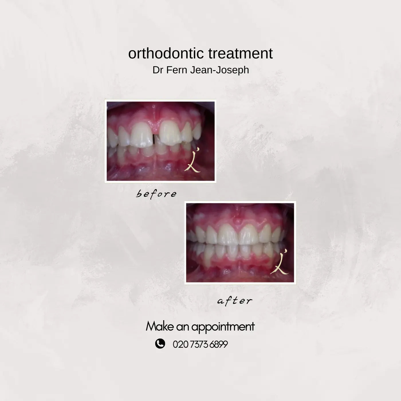 before and after orthodontic treatment solving discrepancy