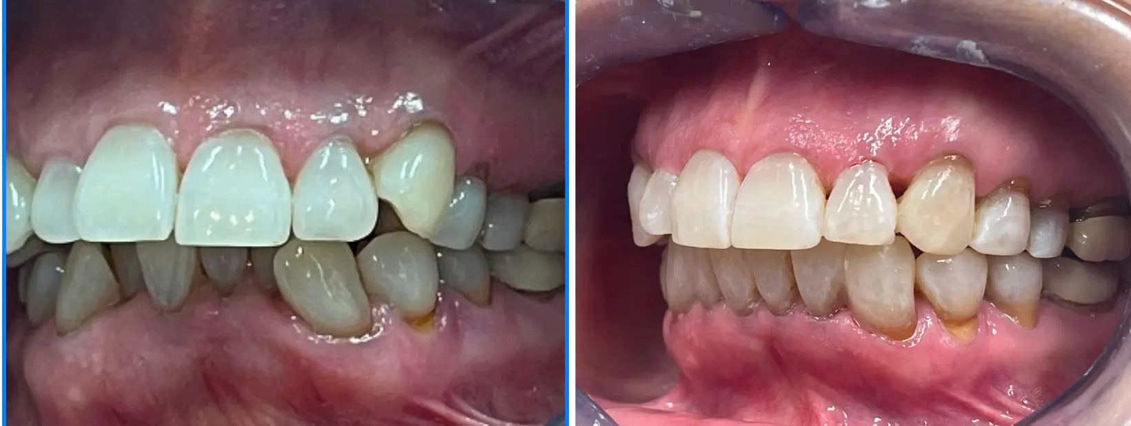 before and after orthodontic treatment teeth alignment and solving bite discrepancy