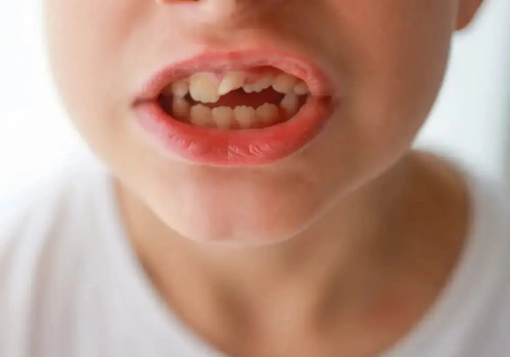 child with an anterior open bite to treat with an orthodontic treatment