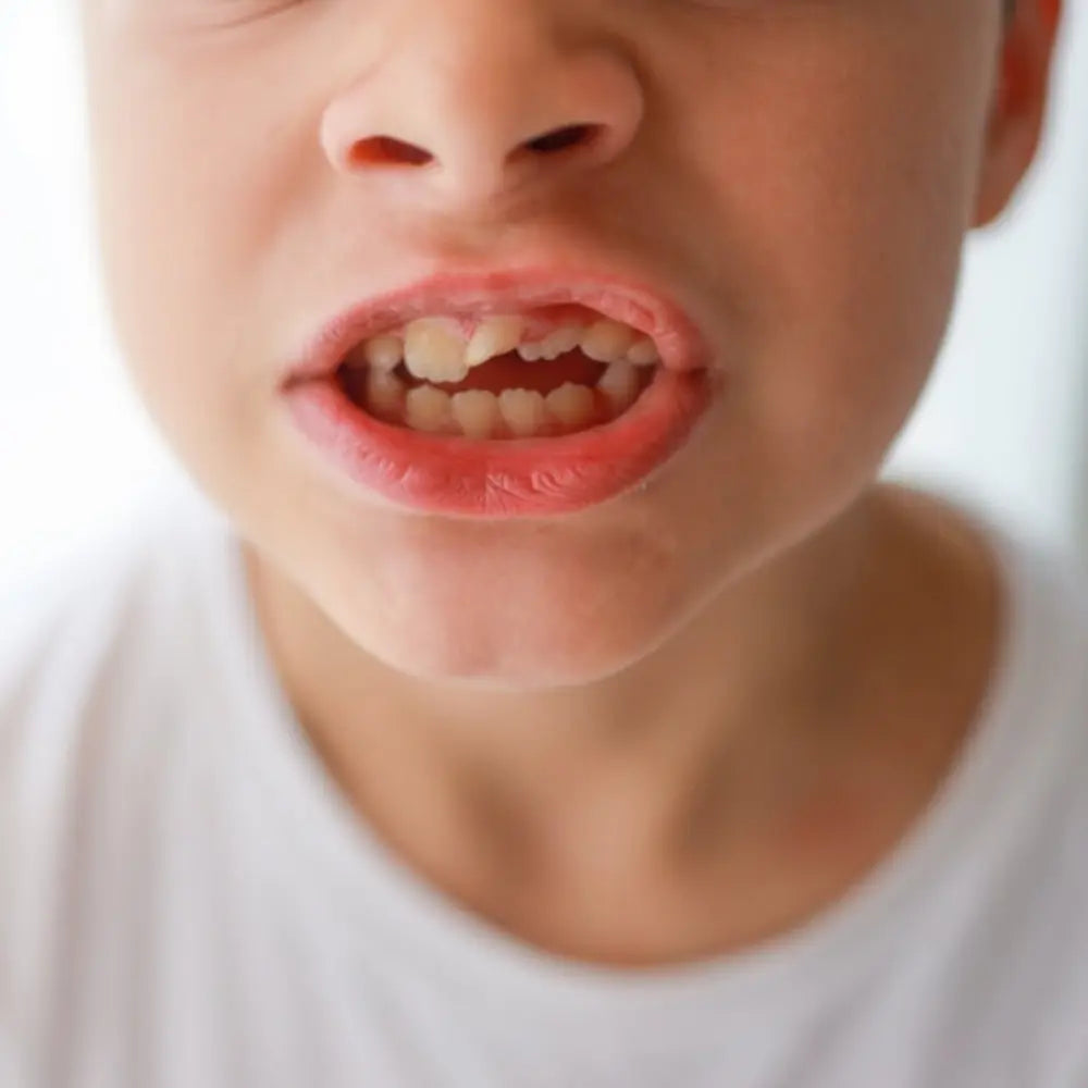 child with an open bite due to sucking his thumb