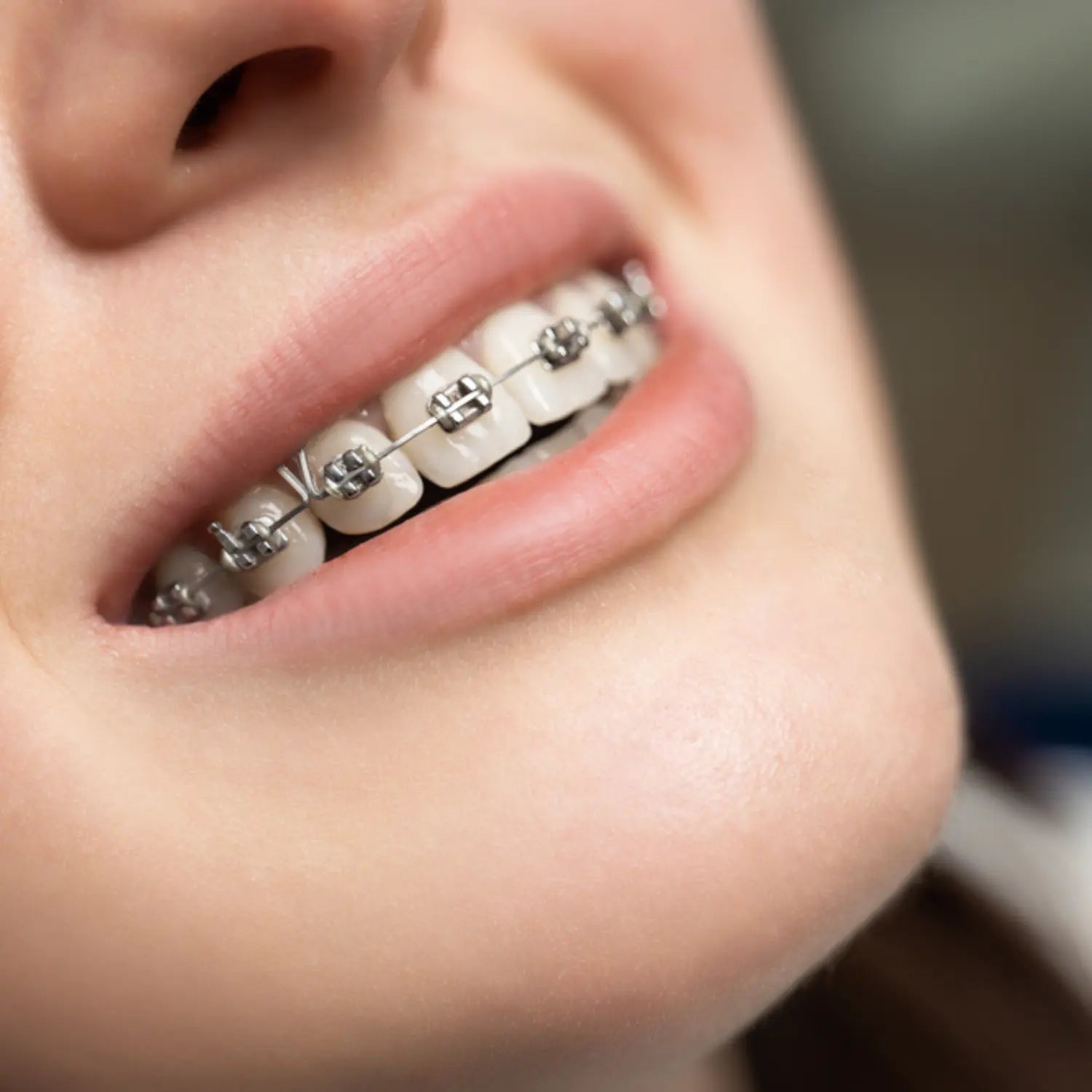 Close-up of a person's mouth with dental braces on a blurred background