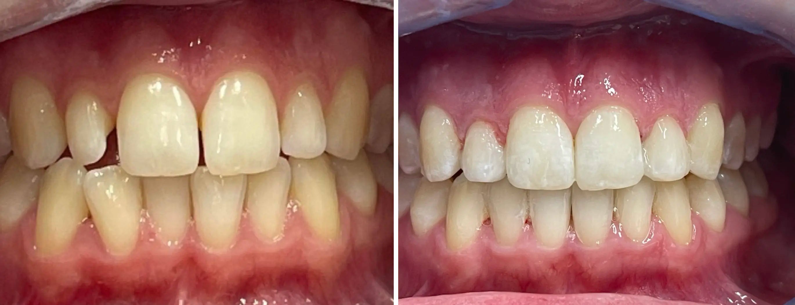 cross bite between teeth before after orthodontic treatment