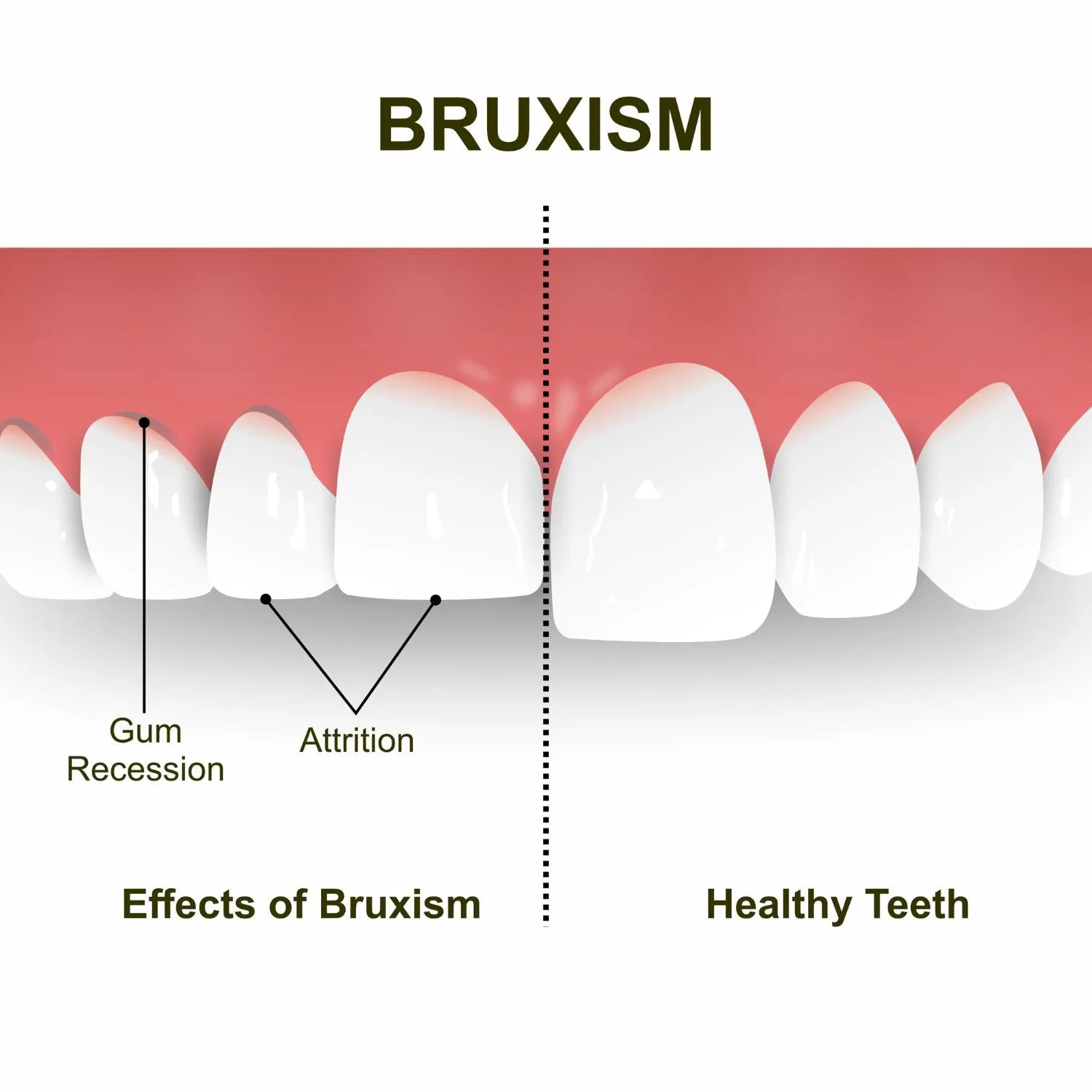 teeth attrition with bruxism